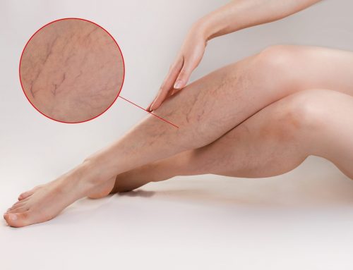 Vein Diseases in America